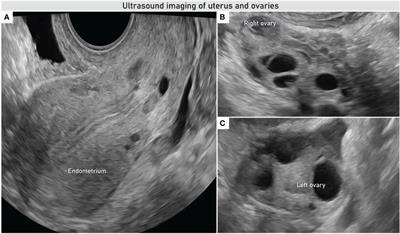 Primary retroperitoneal nodal endometrioid carcinoma associated with Lynch syndrome: A case report